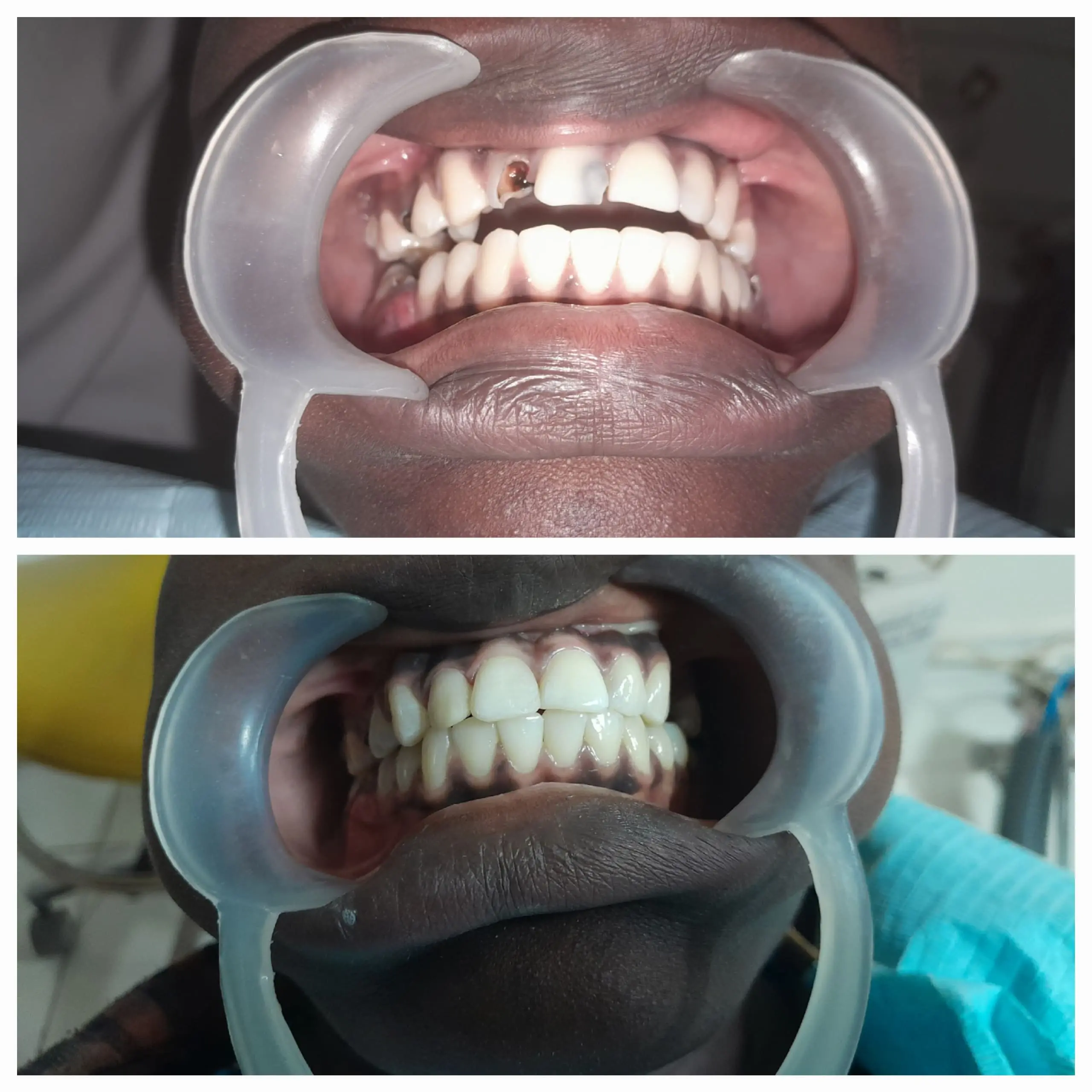 Fillings done at Sterling Dental Clinic
